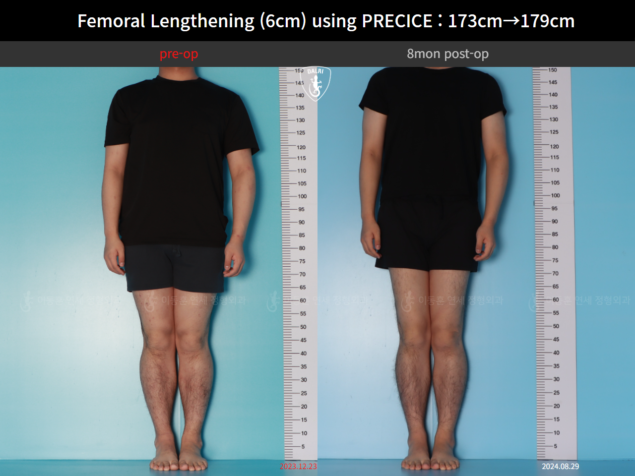 Before and after cll precice, case 89066969, image 1, Dr. Donghoon institute (DALRI)