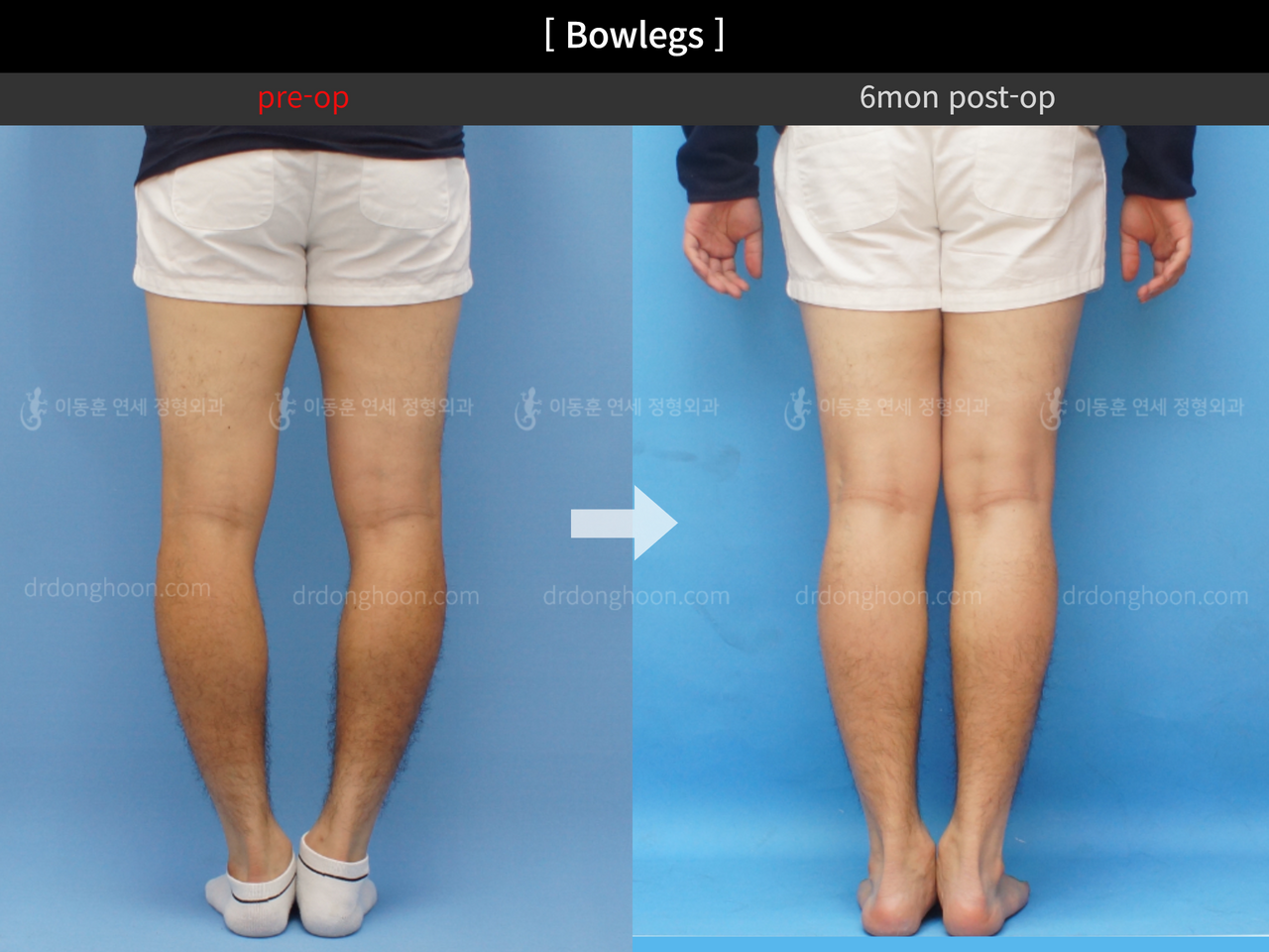 Before and after adult bowlegs, case 4311354, image 4, Dr. Donghoon institute (DALRI)
