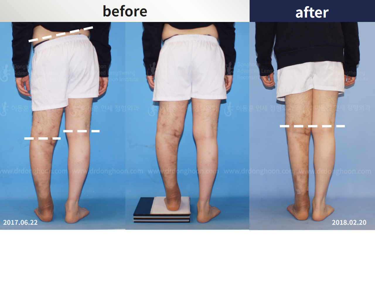 Before and after post-trauma deformity, case 4251791, image 4, Dr. Donghoon institute (DALRI)