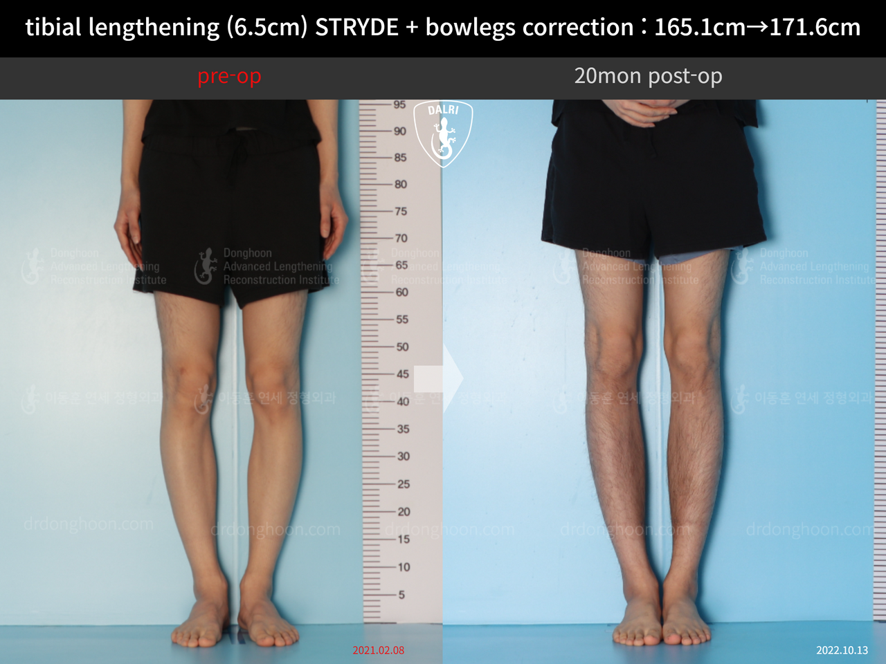 Before and after cll + deformity correction, case 13168253, image 7, Dr. Donghoon institute (DALRI)