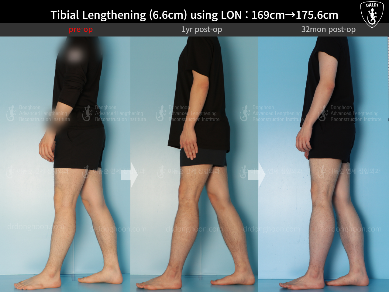 Before and after cll lon, case 15166302, image 4, Dr. Donghoon institute (DALRI)