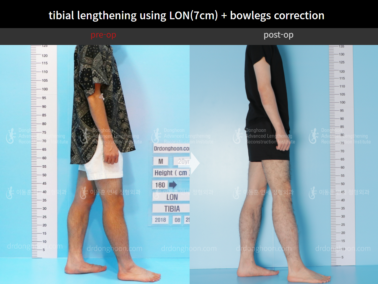 Before and after cll + deformity correction, case 4585644, image 4, Dr. Donghoon institute (DALRI)