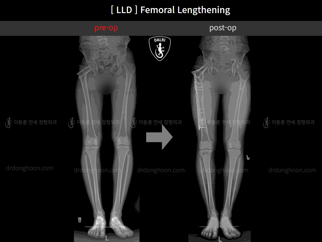 Before and after adult lld, case 11651275, image 5, Dr. Donghoon institute (DALRI)
