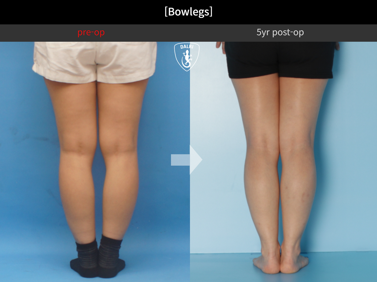 Before and after adult bowlegs, case 13567064, image 4, Dr. Donghoon institute (DALRI)