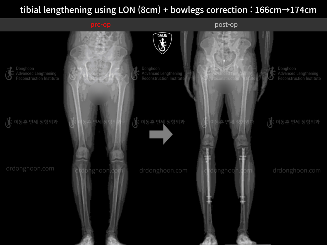 Tibial Lengthening Using (8cm) LON + Bowlegs Correction : 166cm→174cm ...