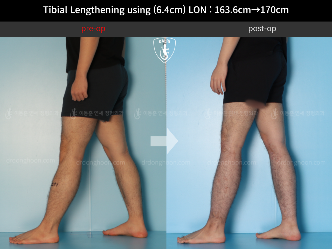 Before and after cll lon, case 12779092, image 8, Dr. Donghoon institute (DALRI)