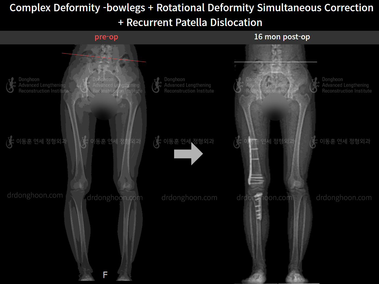 Before and after recurrent patella dislocation, case 8580605, image 8, Dr. Donghoon institute (DALRI)