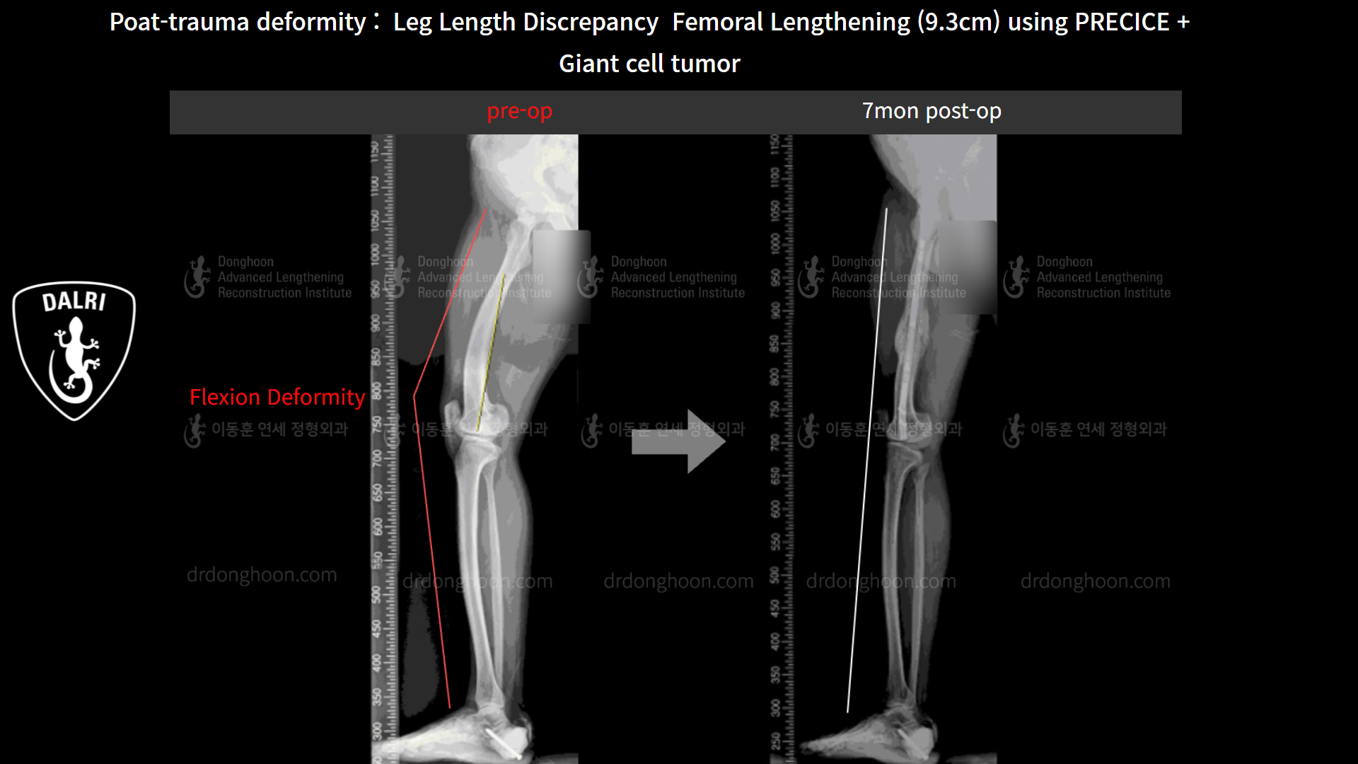 Before and after post-trauma deformity, case 8606746, image 6, Dr. Donghoon institute (DALRI)