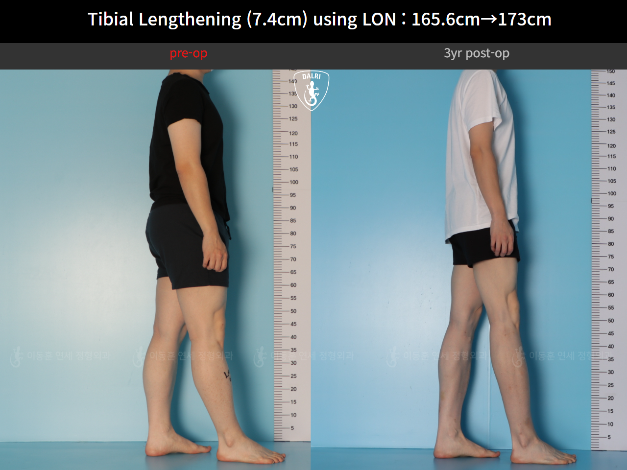Before and after cll lon, case 125561518, image 6, Dr. Donghoon institute (DALRI)