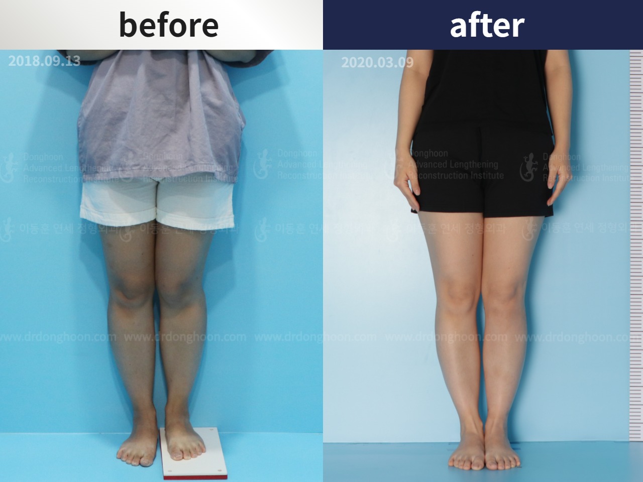 Before and after post-trauma deformity, case 4676458, image 3, Dr. Donghoon institute (DALRI)