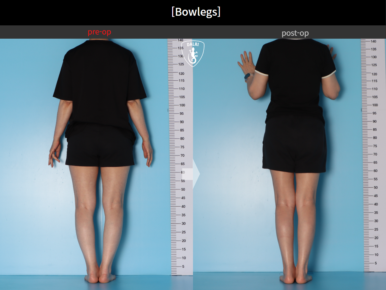 Before and after adult bowlegs, case 30256399, image 4, Dr. Donghoon institute (DALRI)