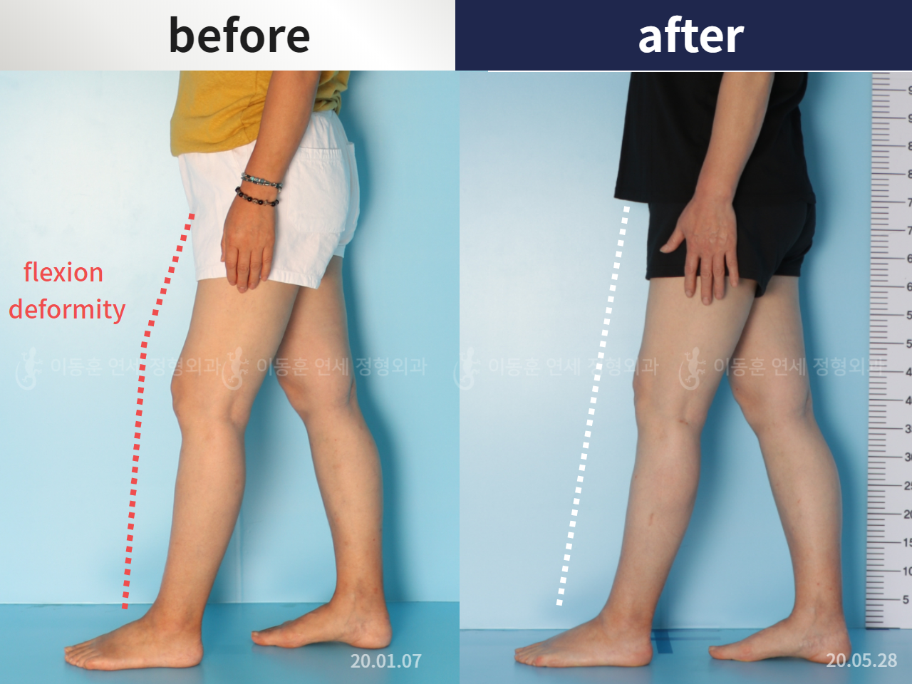 Before and after flexion deformity, case 5987528, image 1, Dr. Donghoon institute (DALRI)