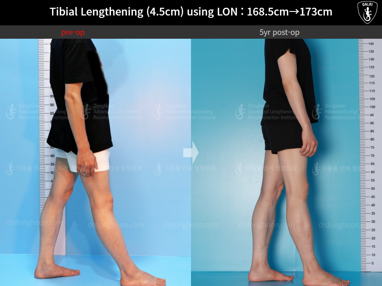 Before and after cll lon, case 16140967, image 5, Dr. Donghoon institute (DALRI)