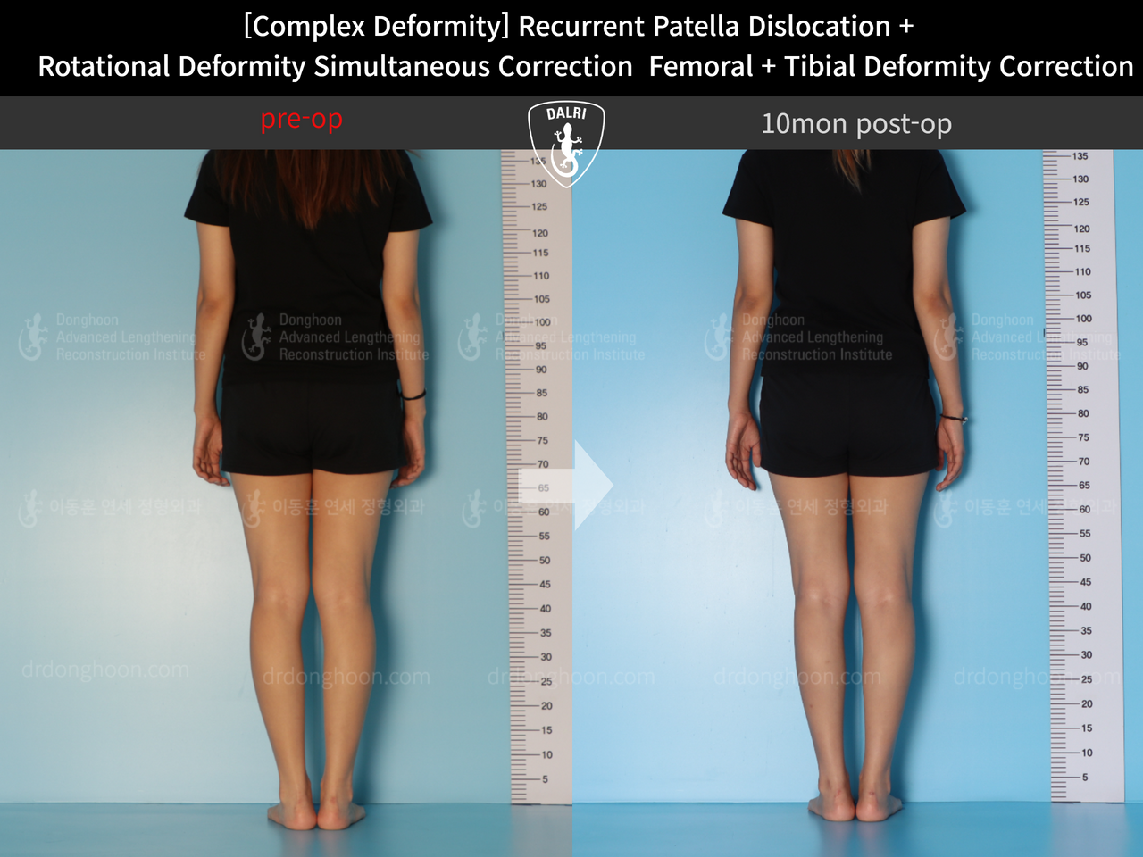 Before and after complex deformity, case 12860892, image 3, Dr. Donghoon institute (DALRI)
