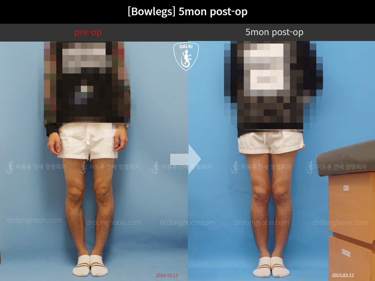 Before and after adult bowlegs, case 4311030, image 1, Dr. Donghoon institute (DALRI)