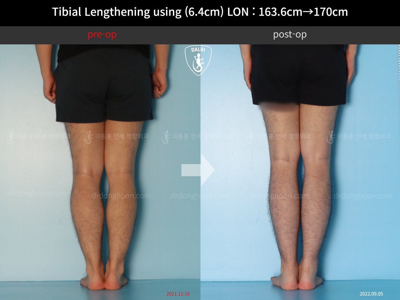 Before and after cll lon, case 12779092, image 6, Dr. Donghoon institute (DALRI)