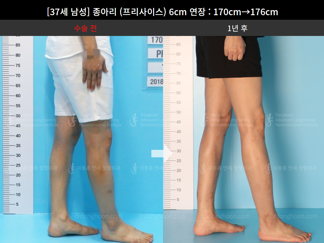 Before and after cll precice, case 4573549, image 6, Dr. Donghoon institute (DALRI)