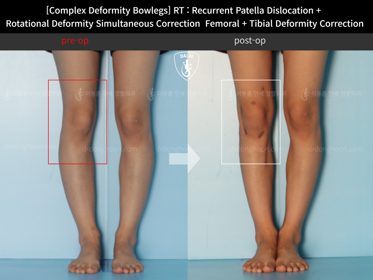 Before and after recurrent patella dislocation, case 12255234, image 2, Dr. Donghoon institute (DALRI)