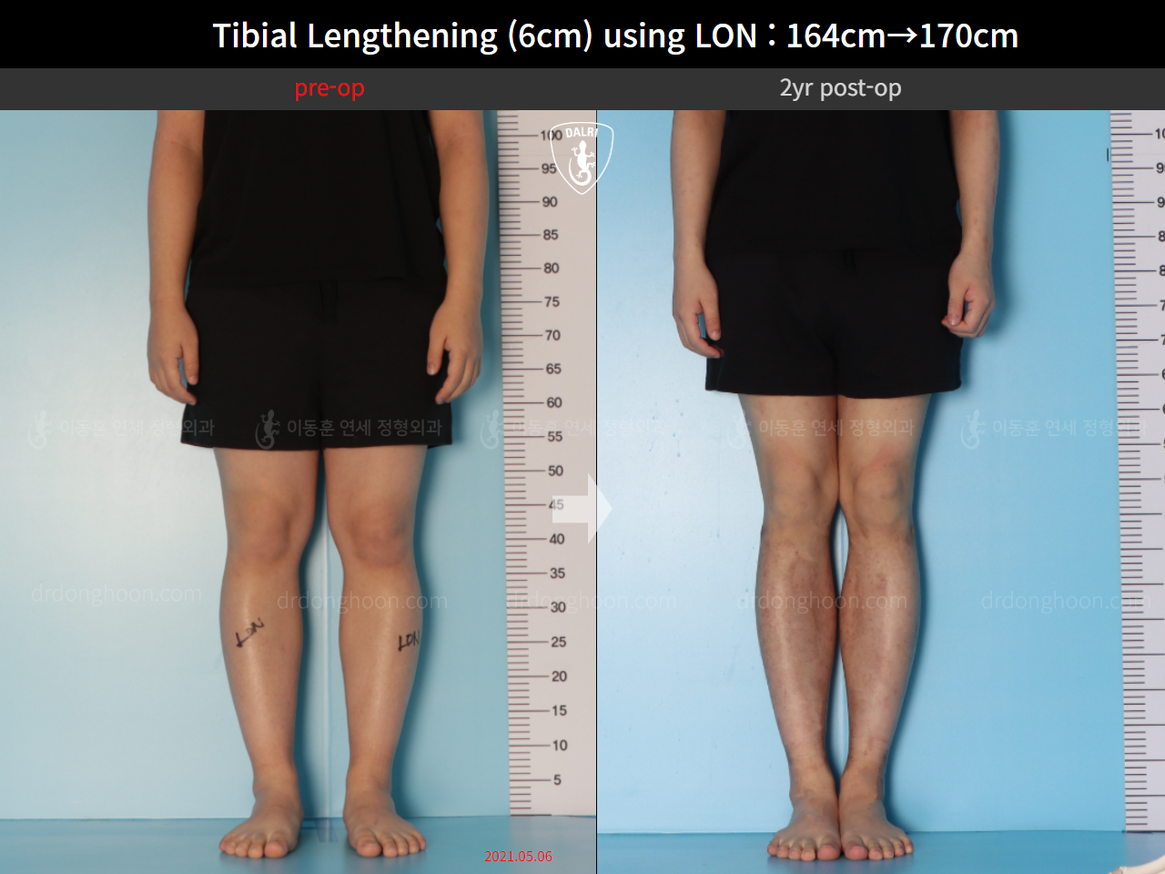 Before and after cll lon, case 15706217, image 3, Dr. Donghoon institute (DALRI)