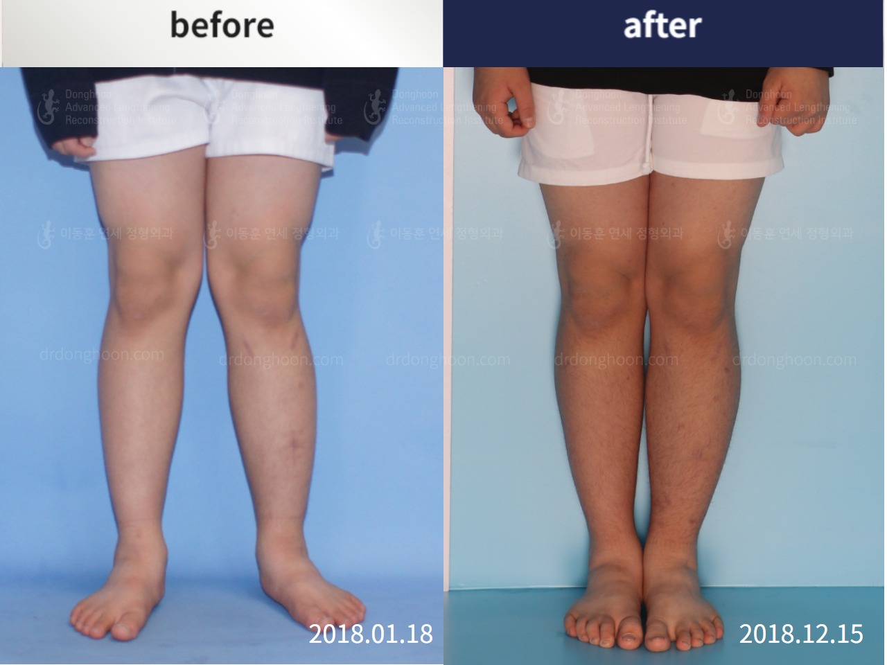 Before and after paediatric & adolescent knock knees, case 4310902, image 1, Dr. Donghoon institute (DALRI)