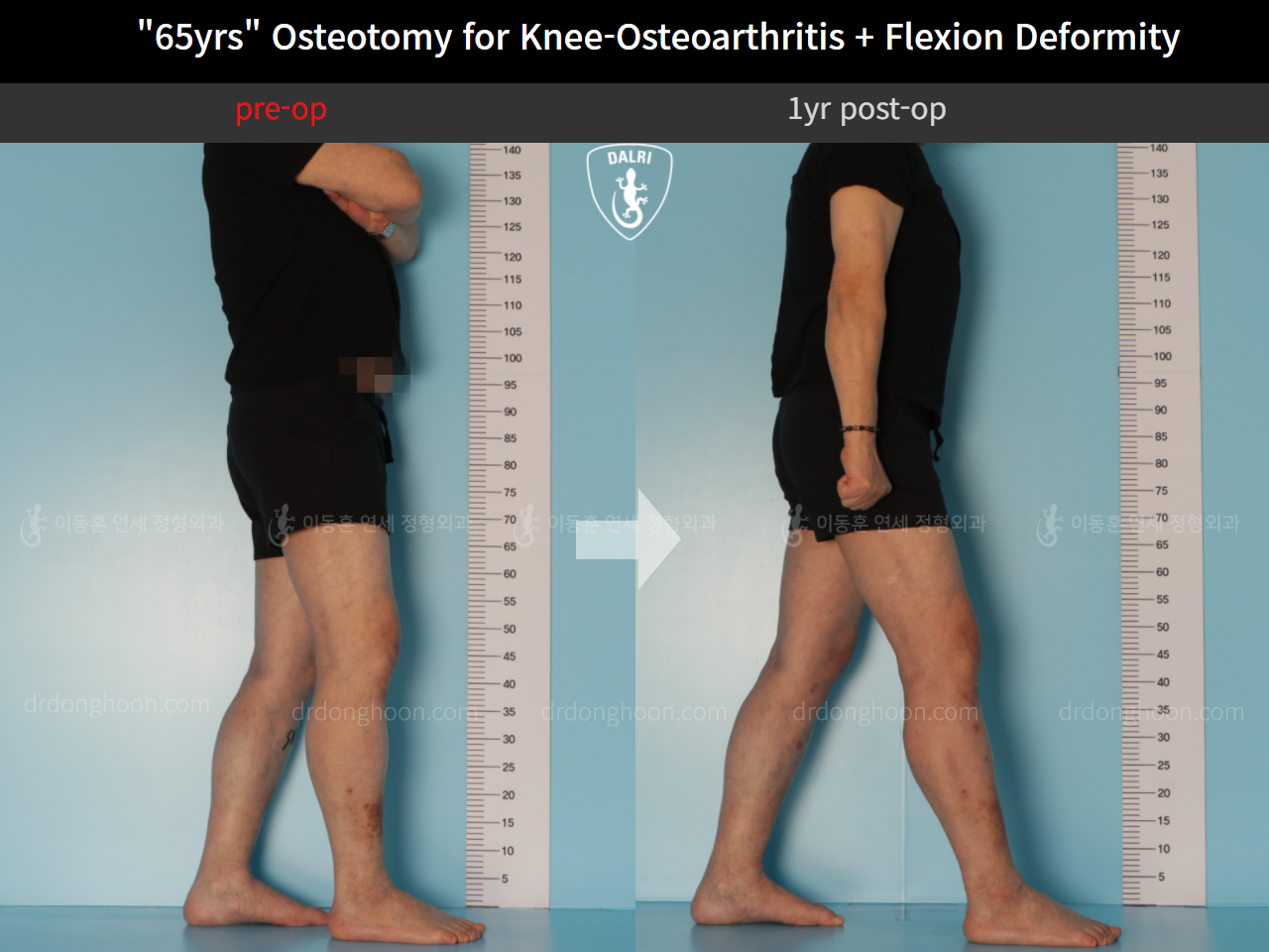 Before and after osteotomy for knee osteoarthritis, case 10742820, image 5, Dr. Donghoon institute (DALRI)