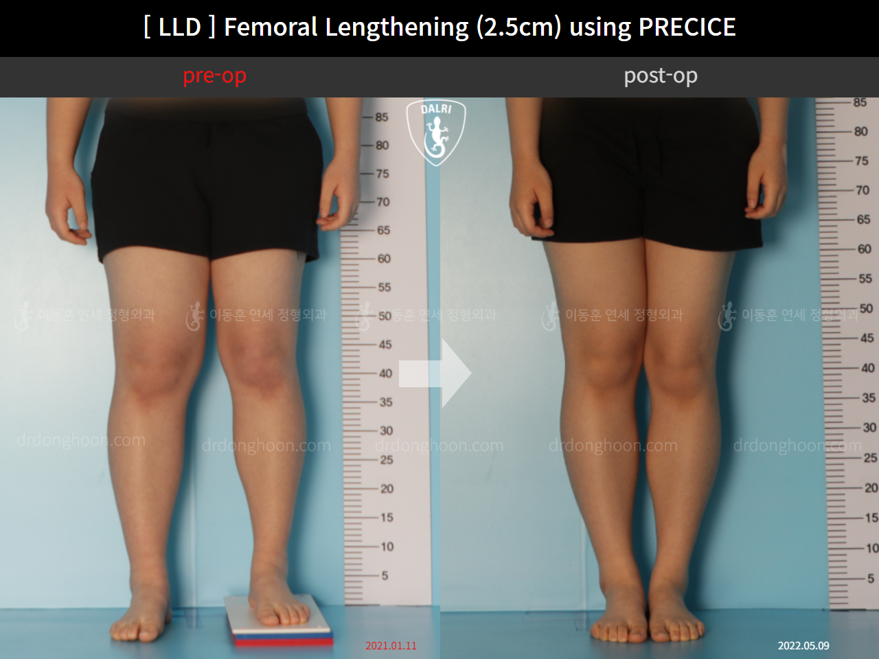 Before and after adult lld, case 11367647, image 5, Dr. Donghoon institute (DALRI)