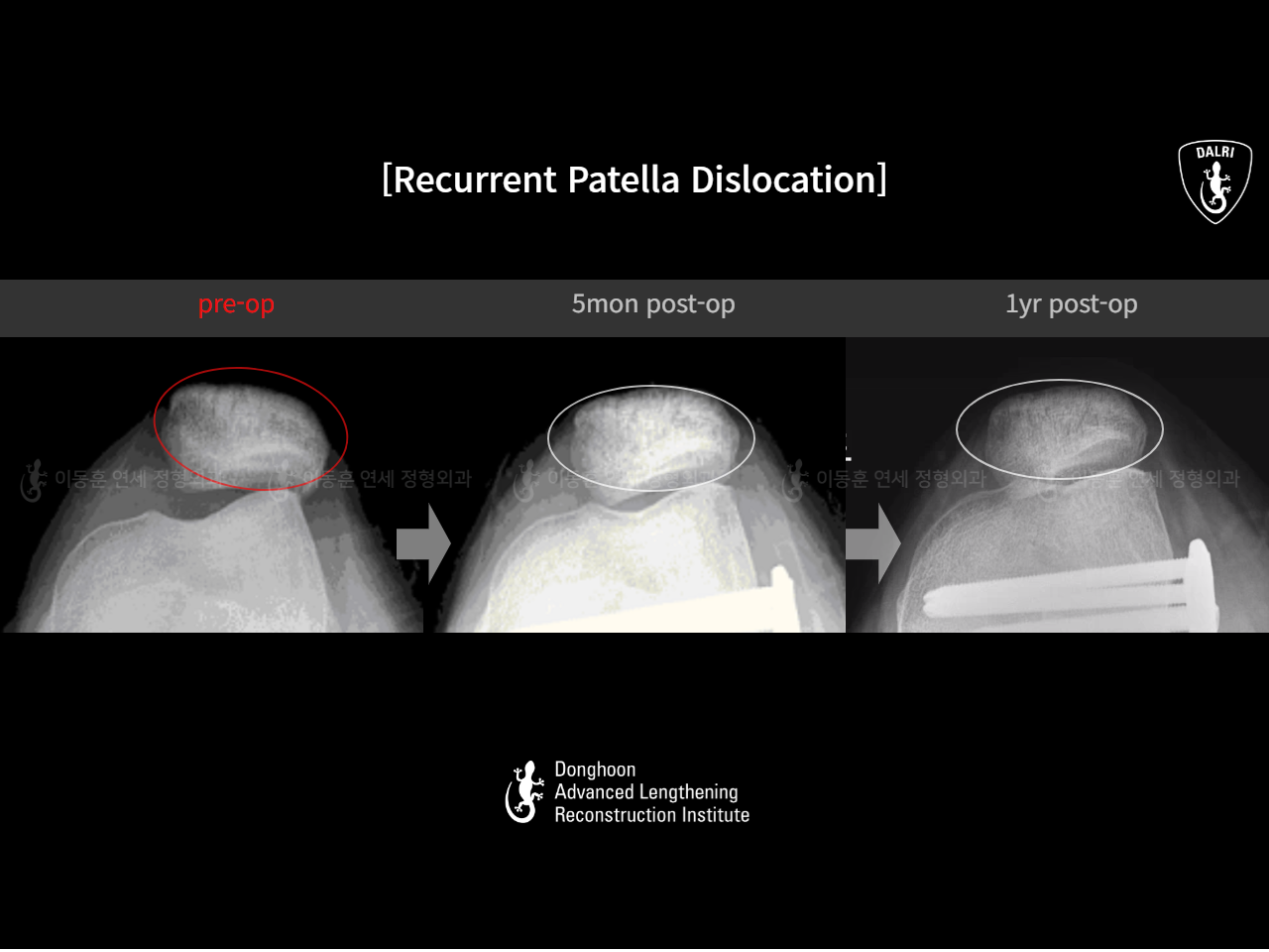 Before and after recurrent patella dislocation, case 15125370, image 8, Dr. Donghoon institute (DALRI)
