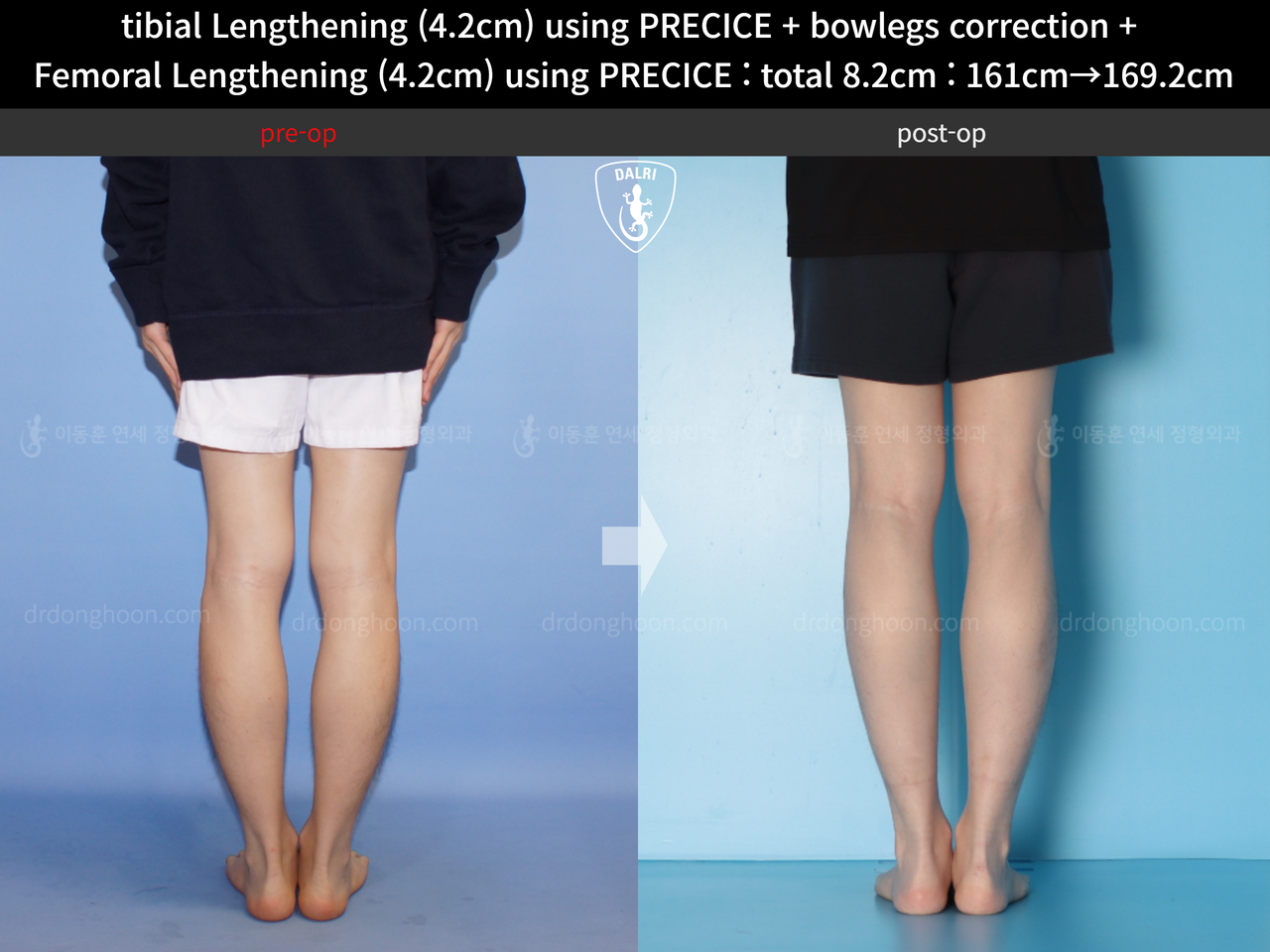 Before and after cll + deformity correction, case 14235715, image 6, Dr. Donghoon institute (DALRI)