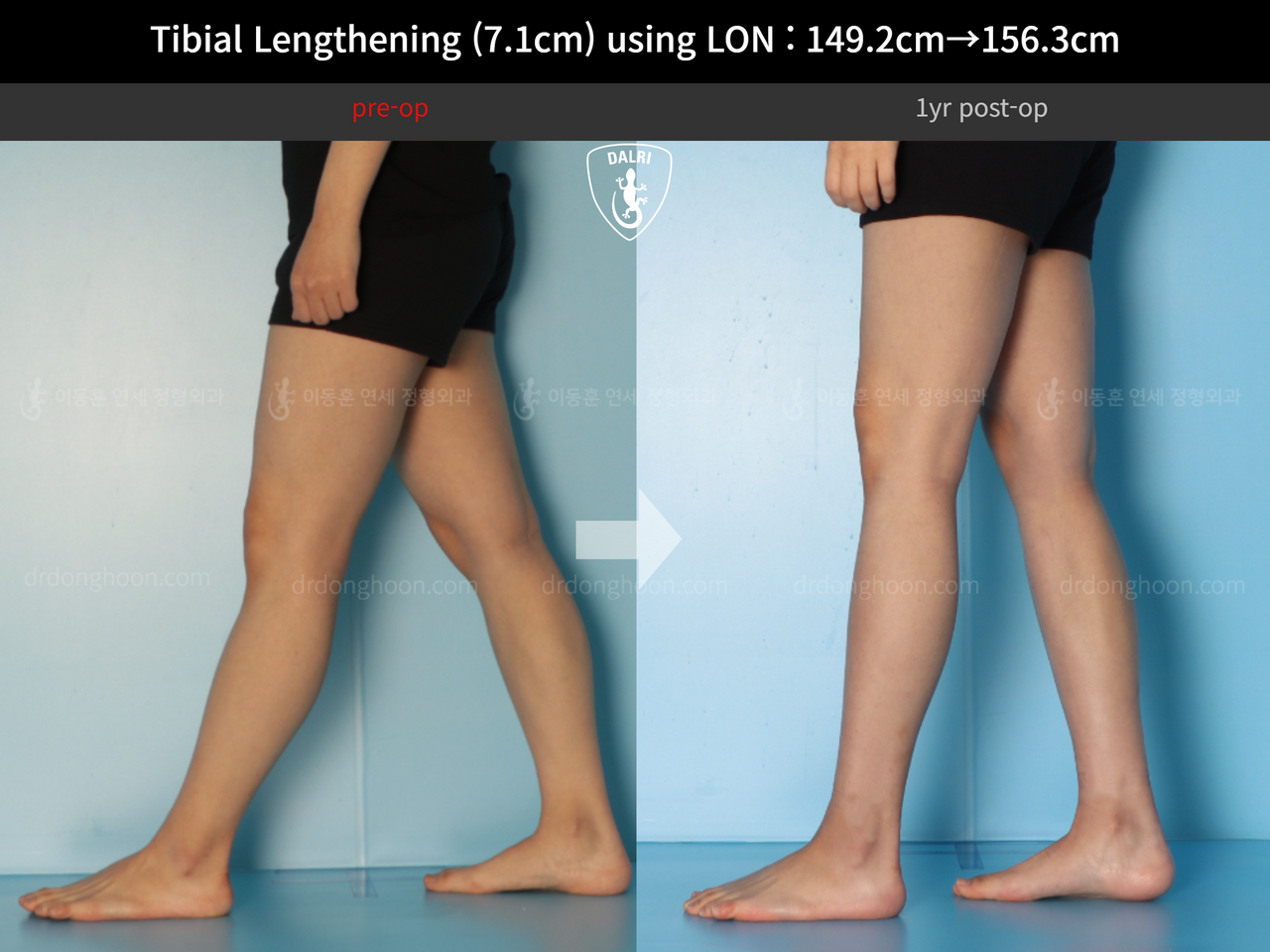 Before and after cll lon, case 14264800, image 8, Dr. Donghoon institute (DALRI)