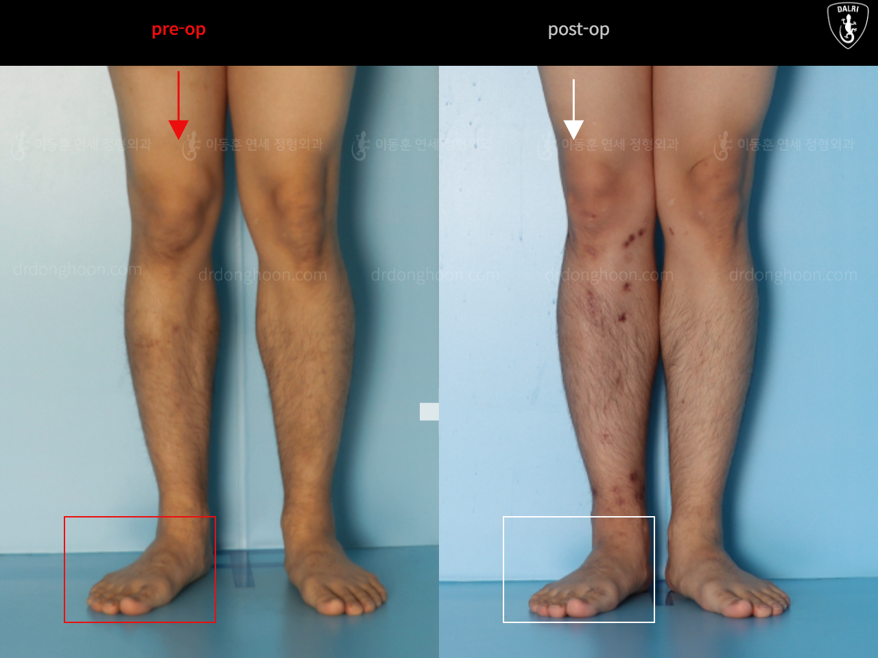 Before and after adult bowlegs, case 16482195, image 5, Dr. Donghoon institute (DALRI)