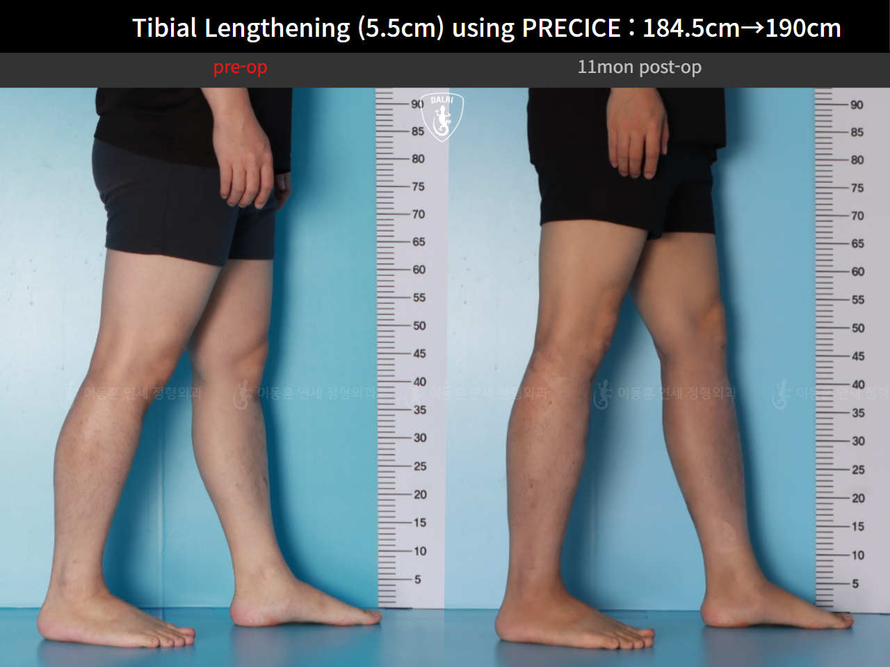 Before and after cll precice, case 125279355, image 10, Dr. Donghoon institute (DALRI)