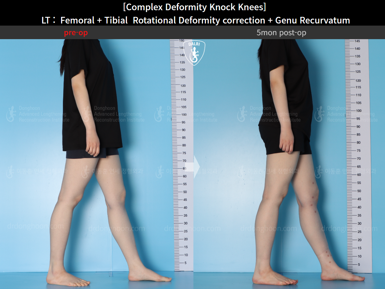 Before and after adult knock knees, case 16212764, image 7, Dr. Donghoon institute (DALRI)