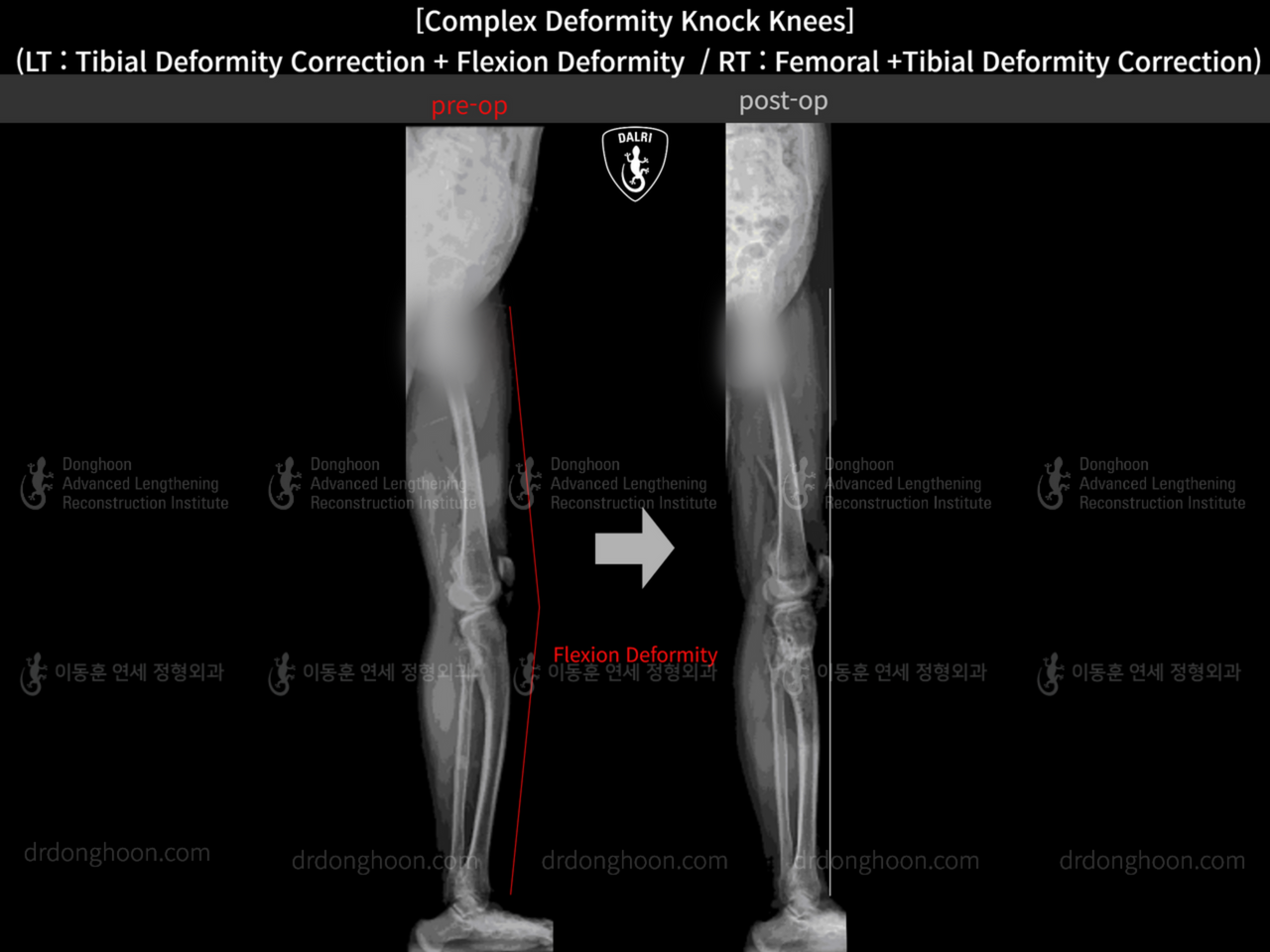 Before and after flexion deformity, case 14439359, image 4, Dr. Donghoon institute (DALRI)