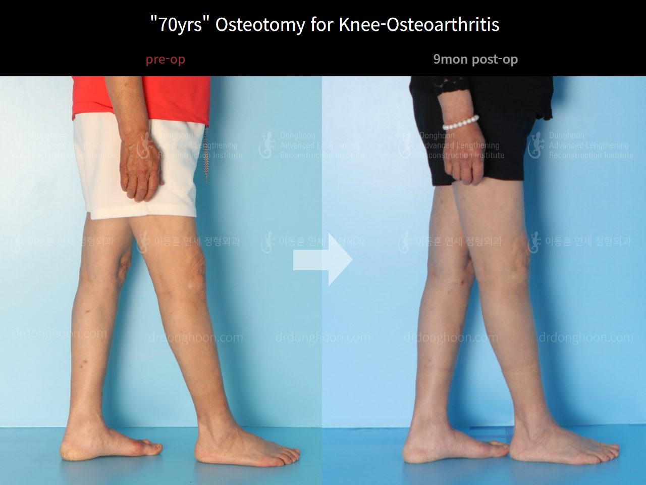 Before and after osteotomy for knee osteoarthritis, case 4306392, image 4, Dr. Donghoon institute (DALRI)