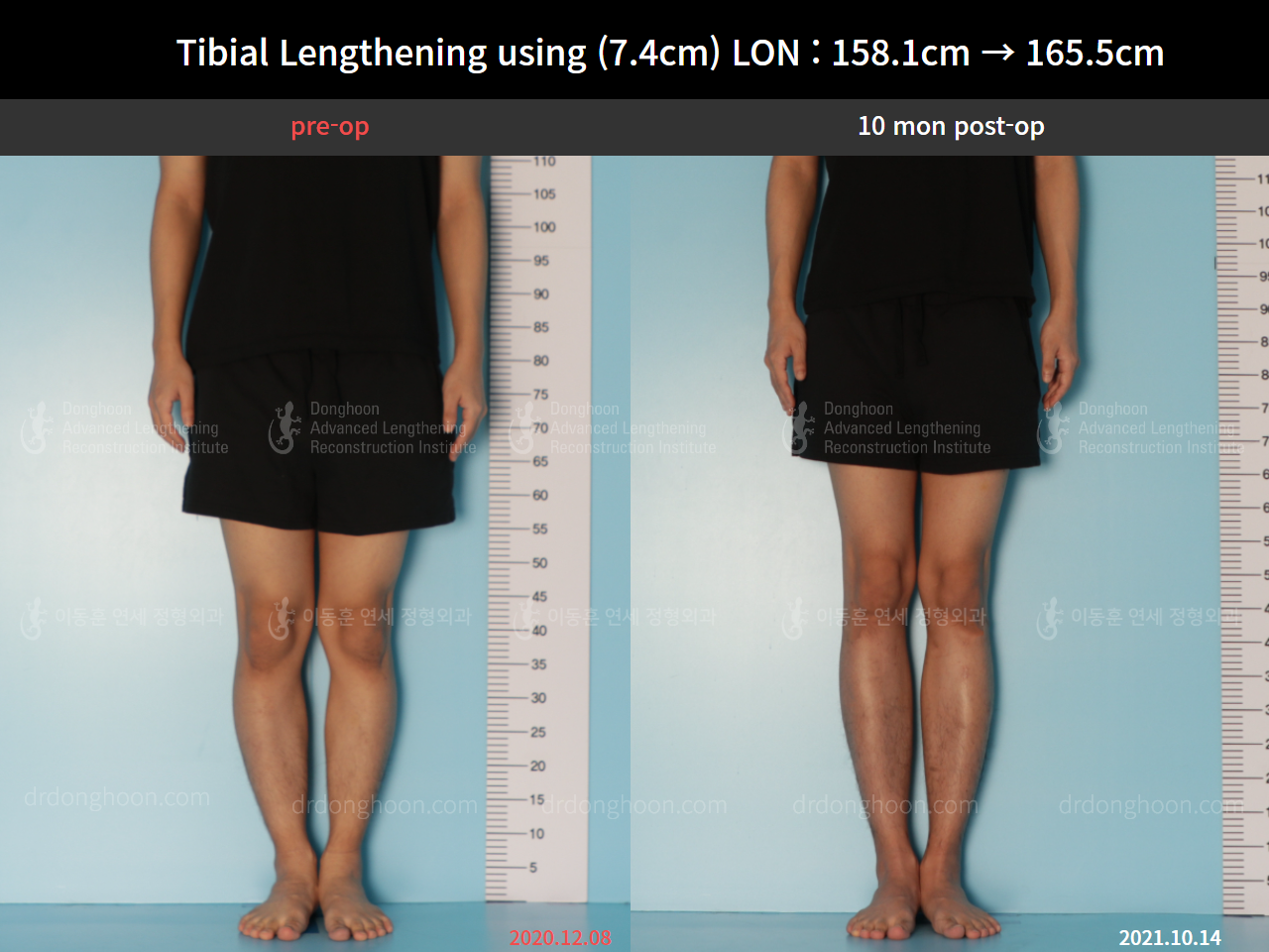 Before and after cll lon, case 8559634, image 5, Dr. Donghoon institute (DALRI)