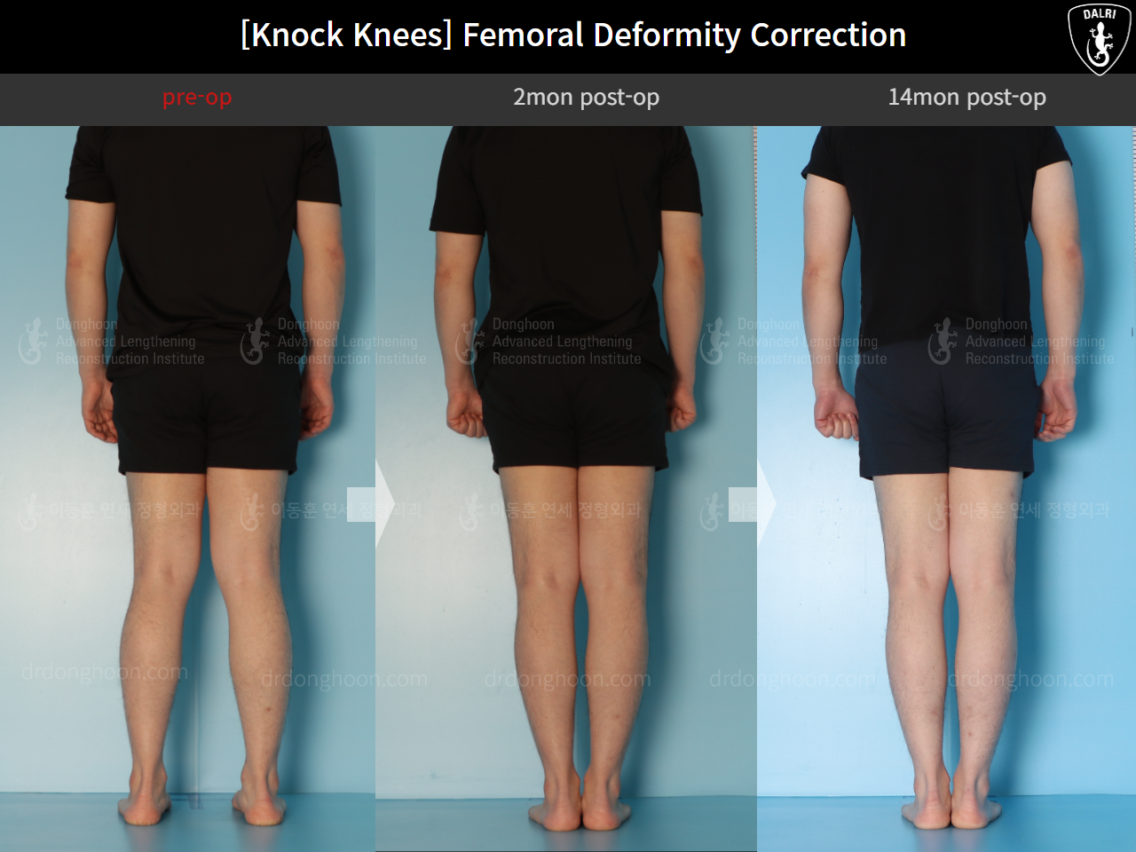 Before and after adult knock knees, case 15816319, image 2, Dr. Donghoon institute (DALRI)