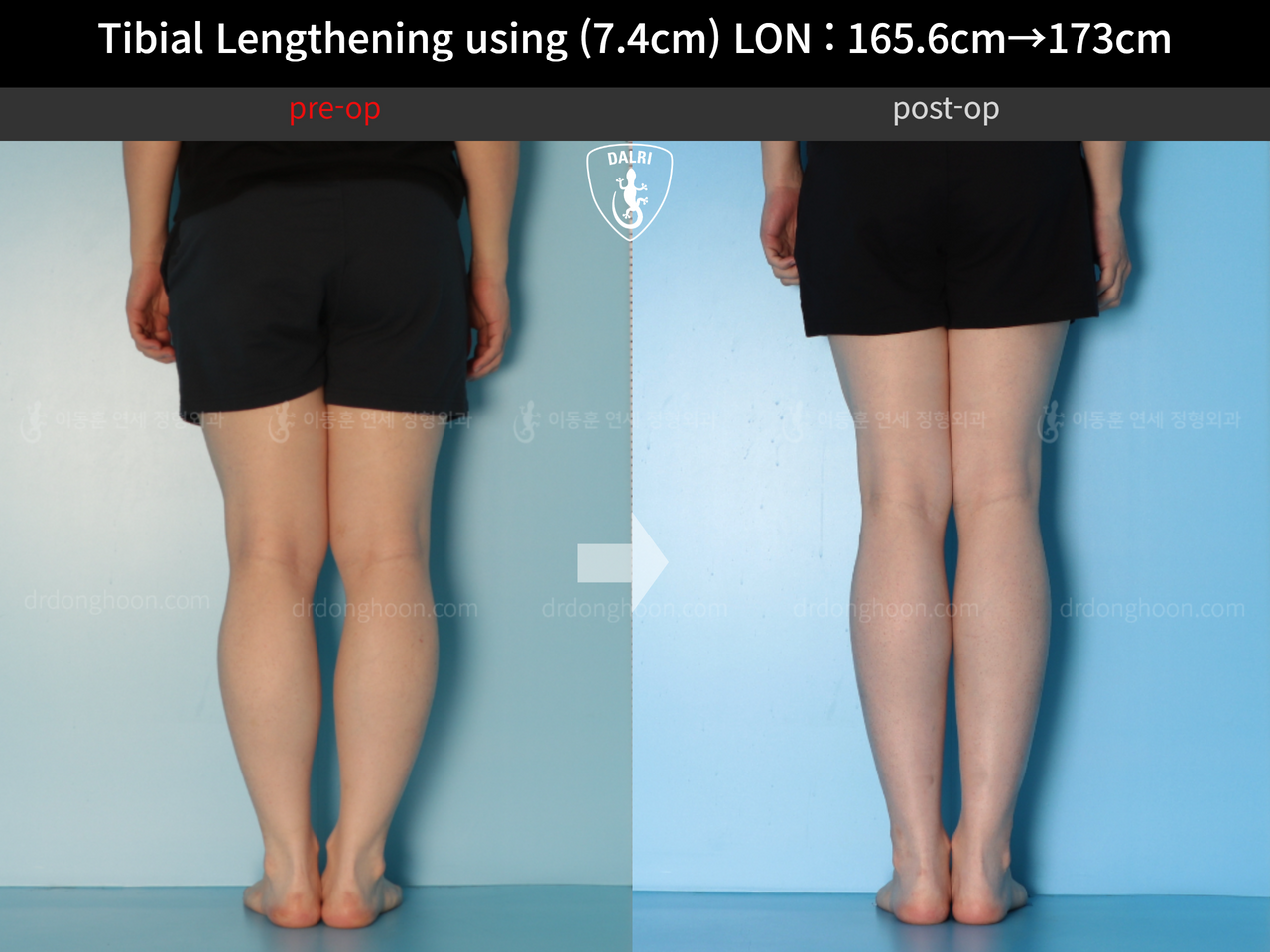 Before and after cll lon, case 13634644, image 6, Dr. Donghoon institute (DALRI)