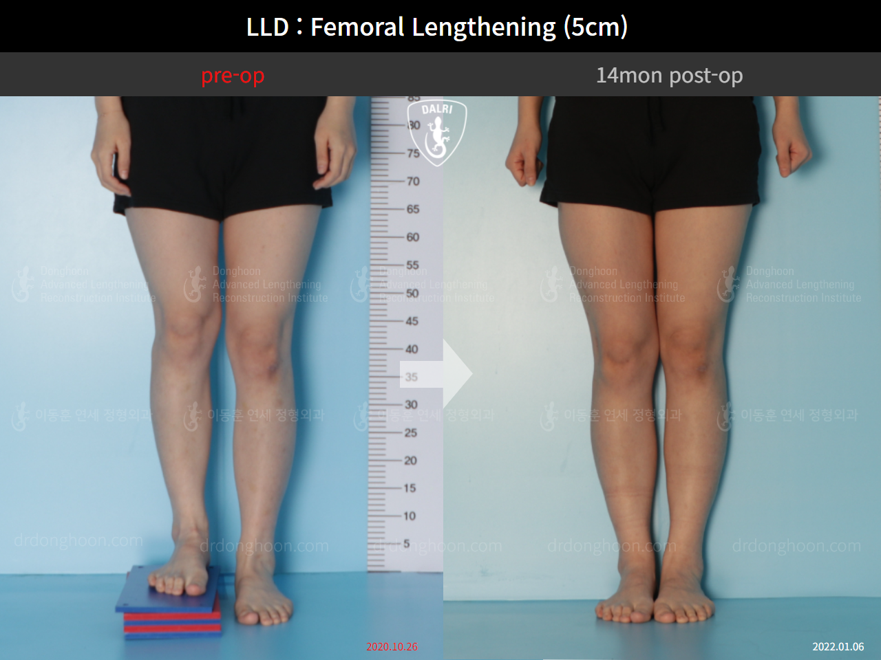 Before and after adult lld, case 9366304, image 6, Dr. Donghoon institute (DALRI)