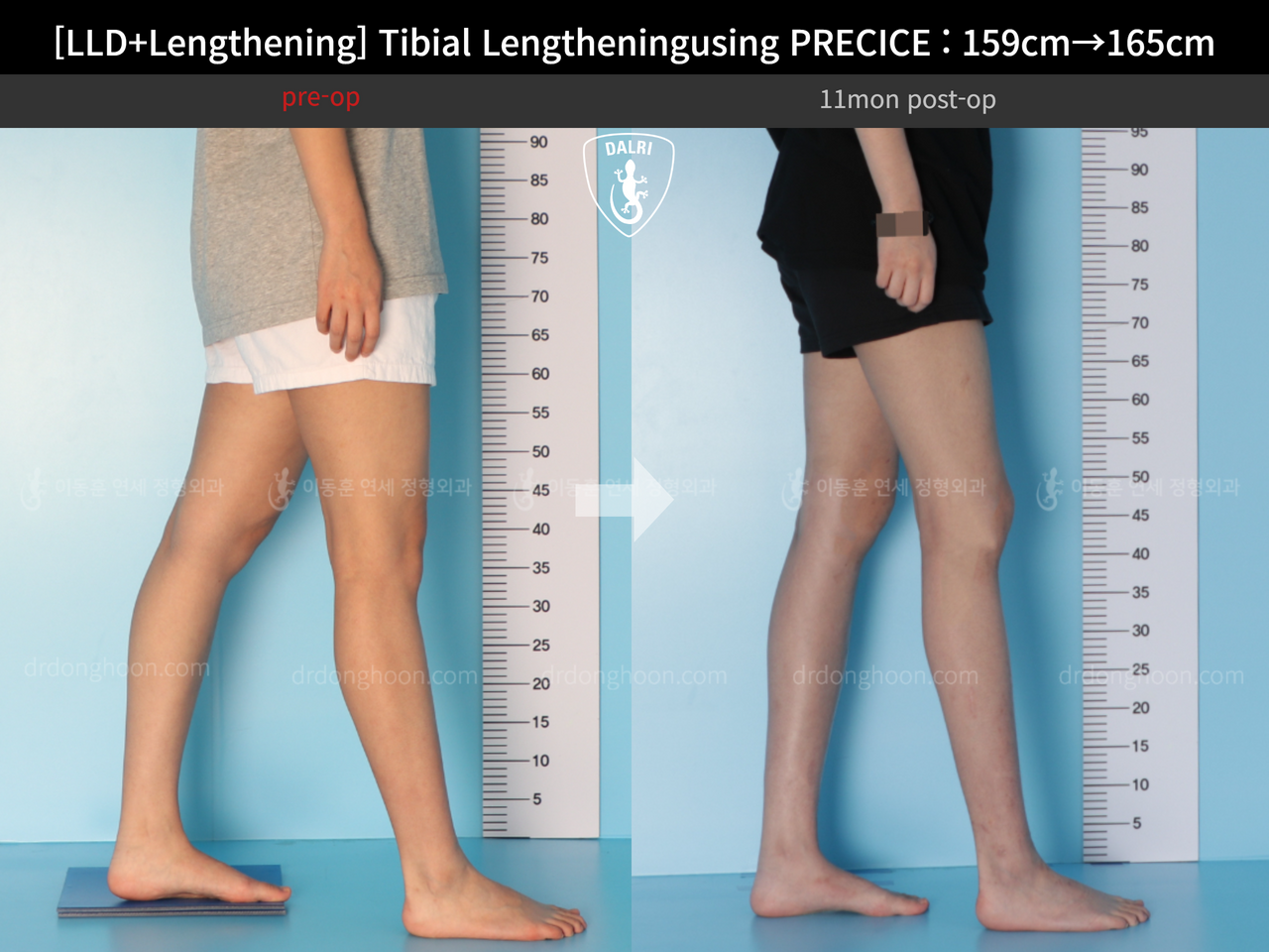 Before and after cll precice, case 13252418, image 8, Dr. Donghoon institute (DALRI)