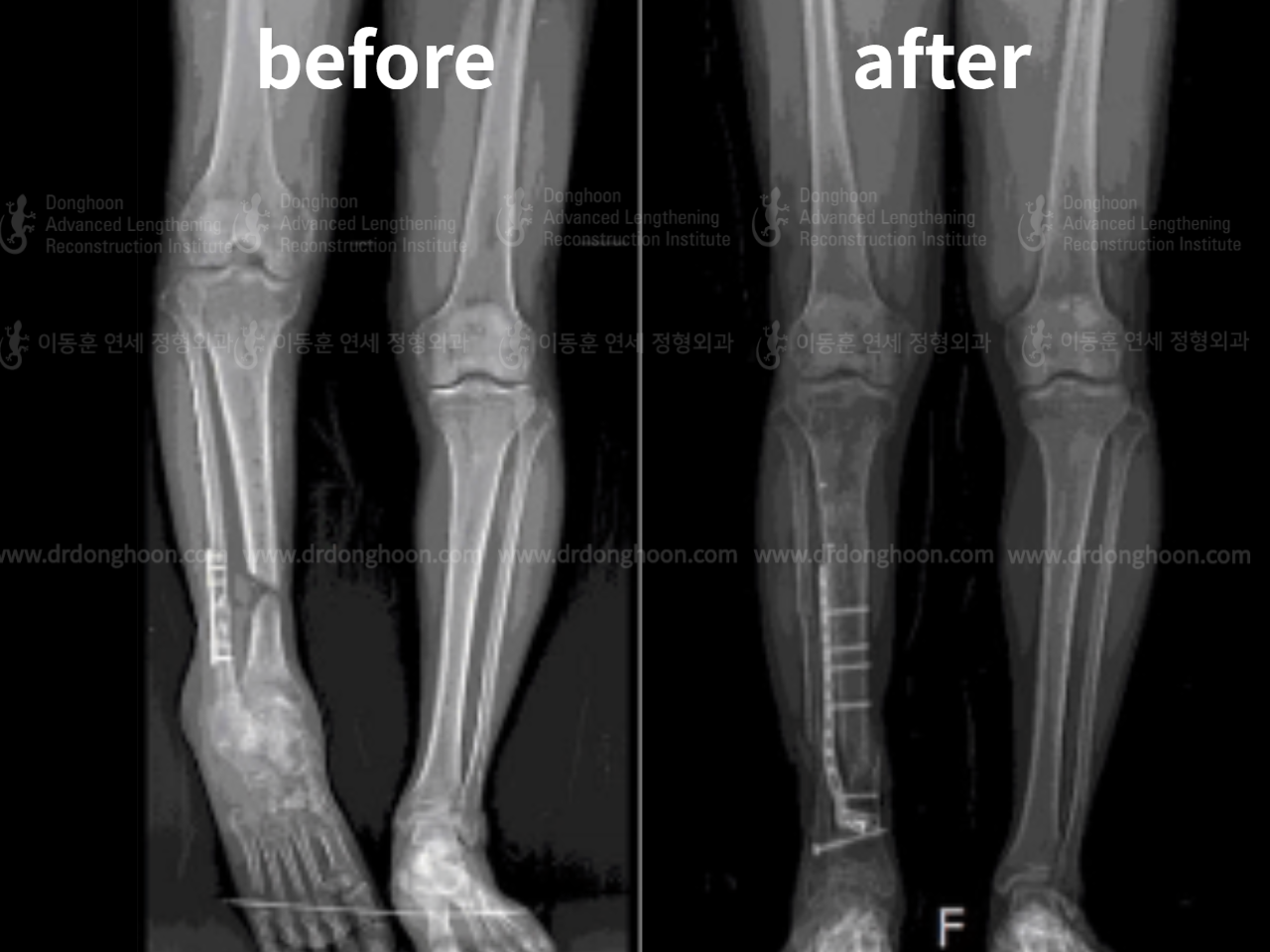 Before and after post-trauma deformity, case 4251787, image 4, Dr. Donghoon institute (DALRI)