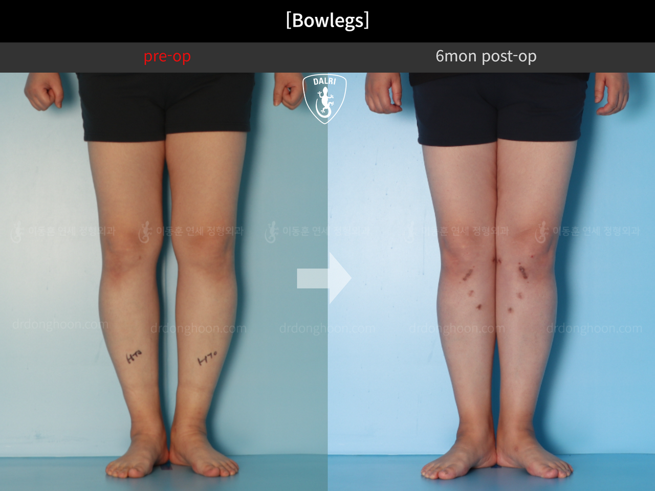 Before and after adult bowlegs, case 12396052, image 6, Dr. Donghoon institute (DALRI)