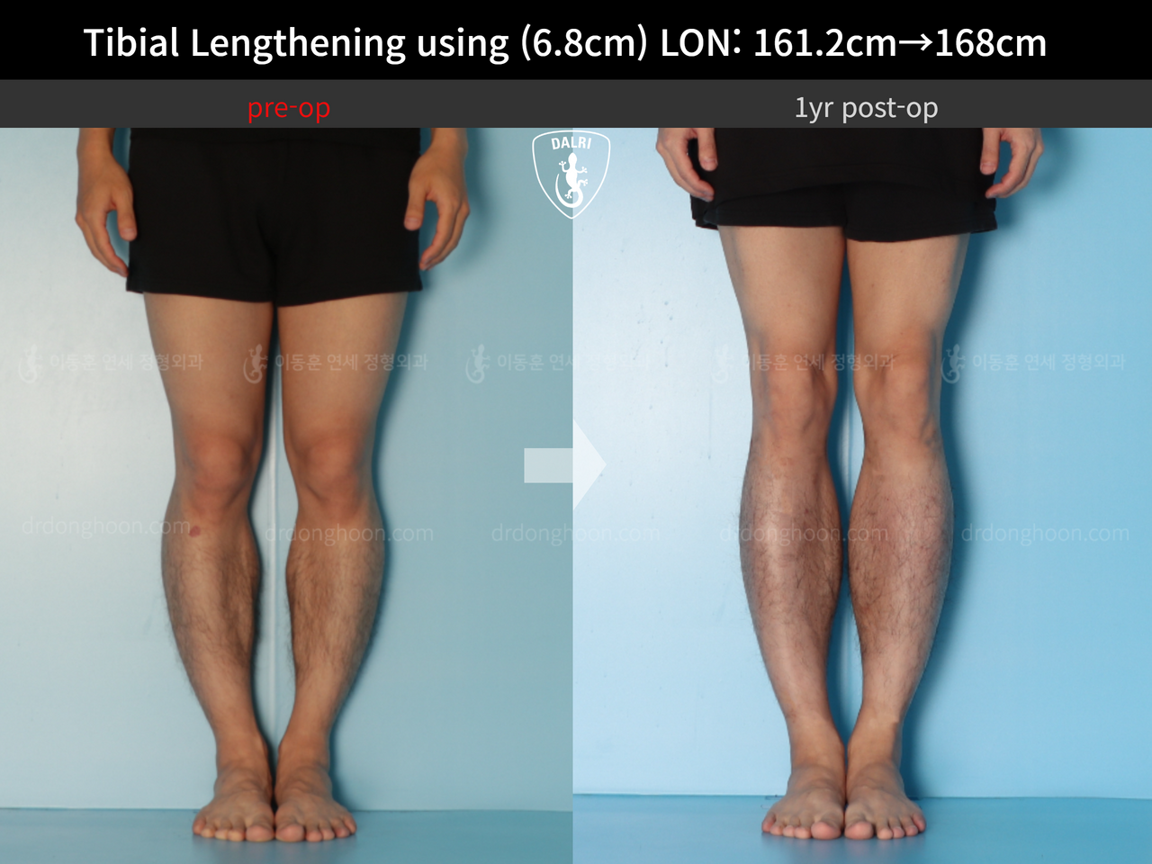 Before and after cll lon, case 13633878, image 7, Dr. Donghoon institute (DALRI)