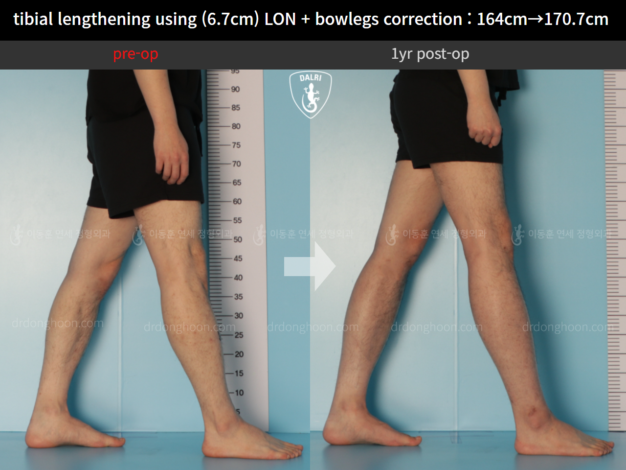 Before and after cll lon, case 11037334, image 7, Dr. Donghoon institute (DALRI)