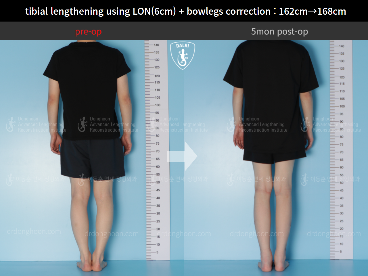 Before and after cll + deformity correction, case 5316038, image 2, Dr. Donghoon institute (DALRI)
