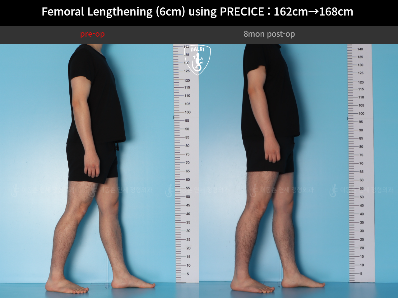 Before and after cll precice, case 52565195, image 6, Dr. Donghoon institute (DALRI)