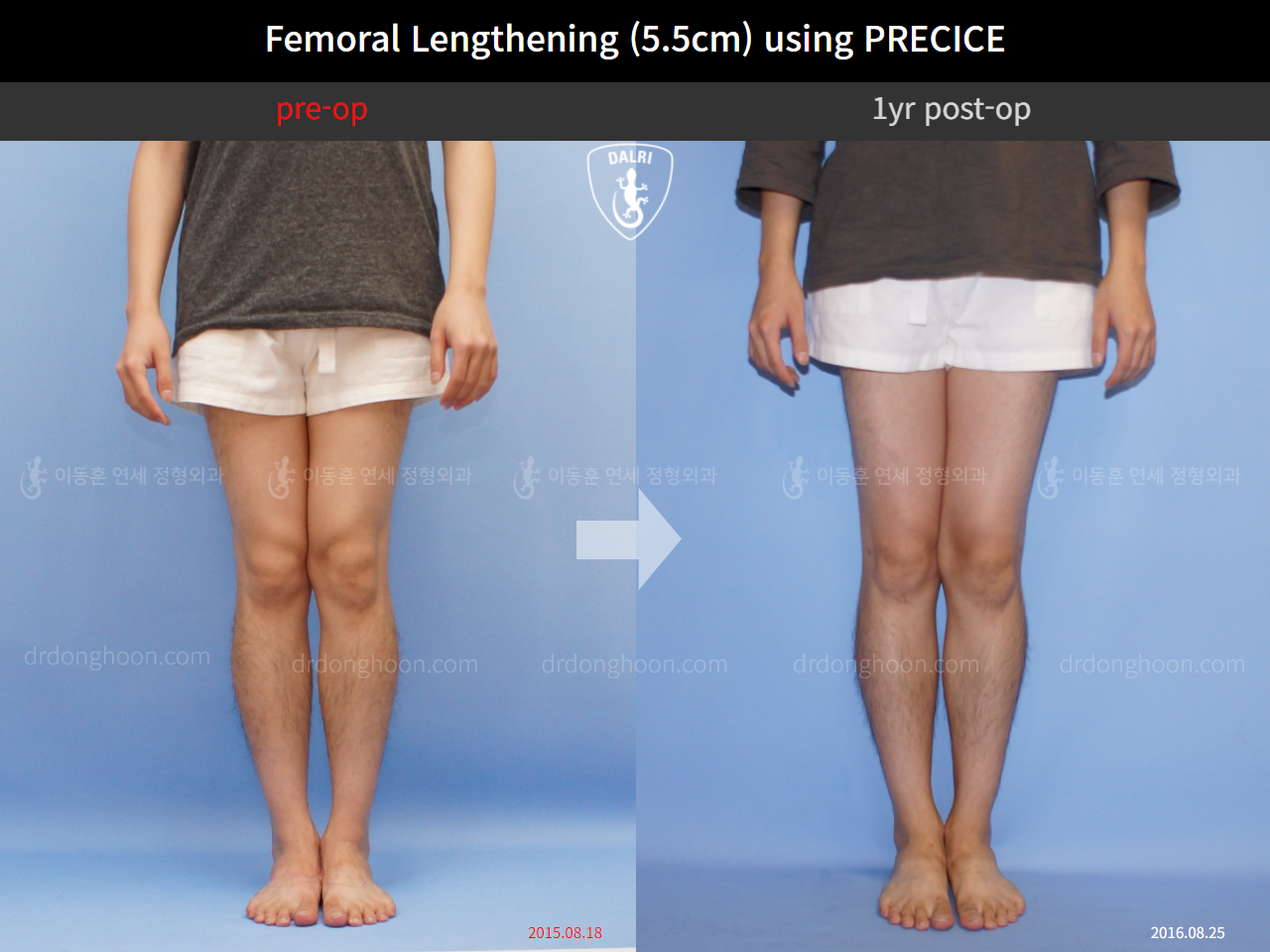 Before and after cll precice, case 4323383, image 5, Dr. Donghoon institute (DALRI)