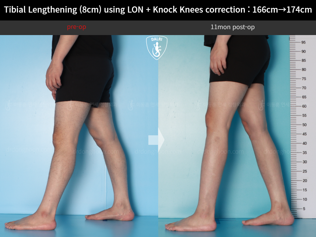 Before and after cll + deformity correction, case 20789954, image 10, Dr. Donghoon institute (DALRI)