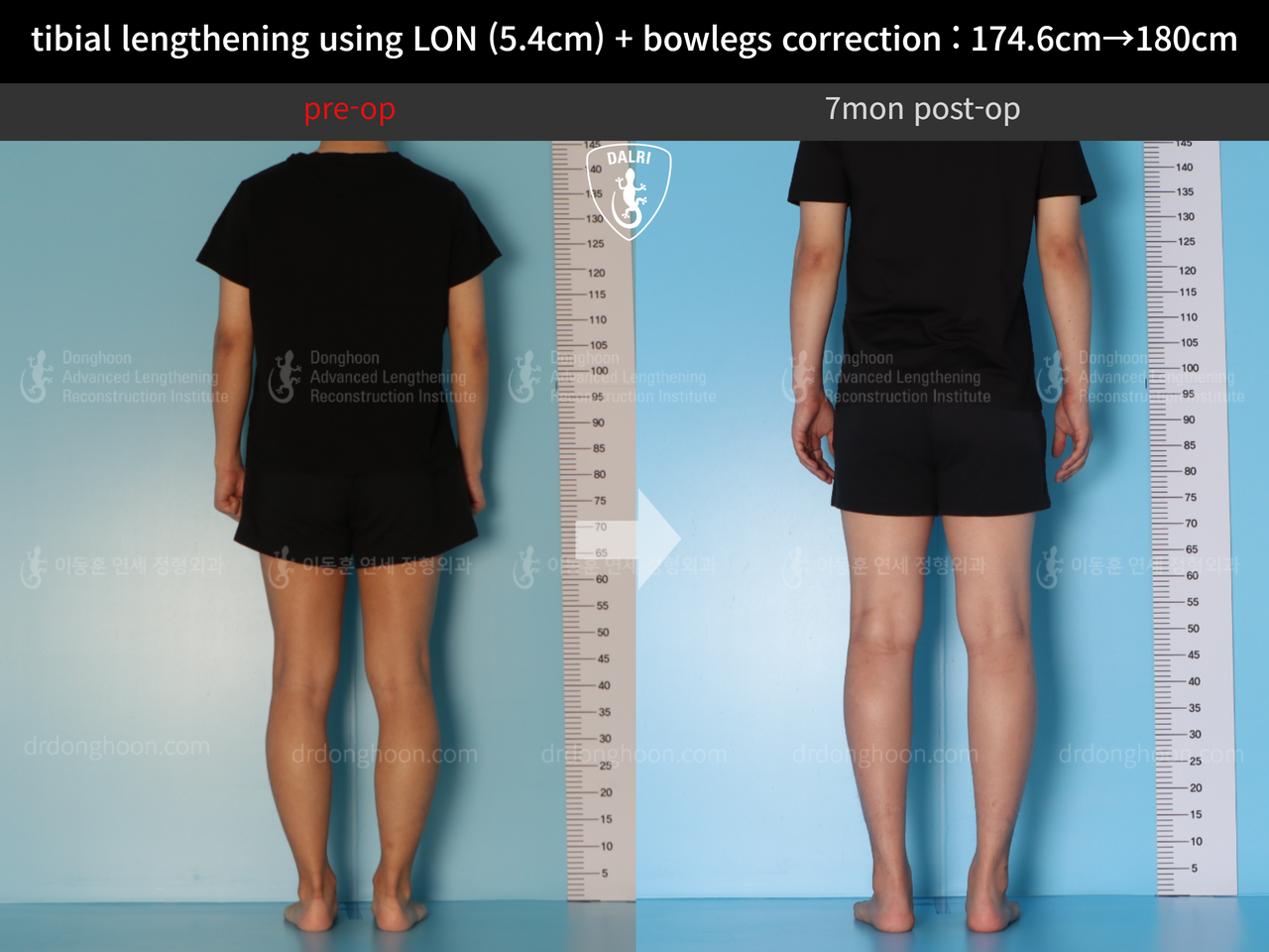 Before and after cll + deformity correction, case 12718558, image 4, Dr. Donghoon institute (DALRI)