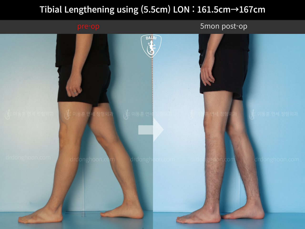Before and after cll lon, case 12641751, image 8, Dr. Donghoon institute (DALRI)