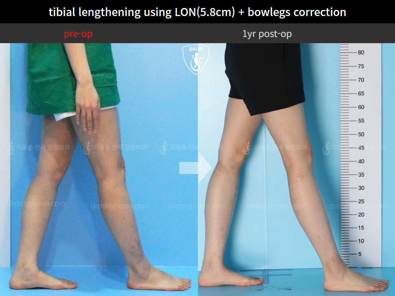 Before and after cll + deformity correction, case 11210566, image 7, Dr. Donghoon institute (DALRI)